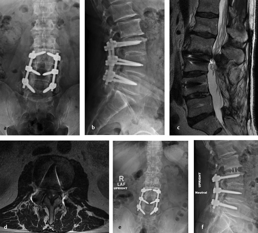 Minimally Invasive Lateral Transpsoas Interbody Lumbar Fusion | Neupsy Key