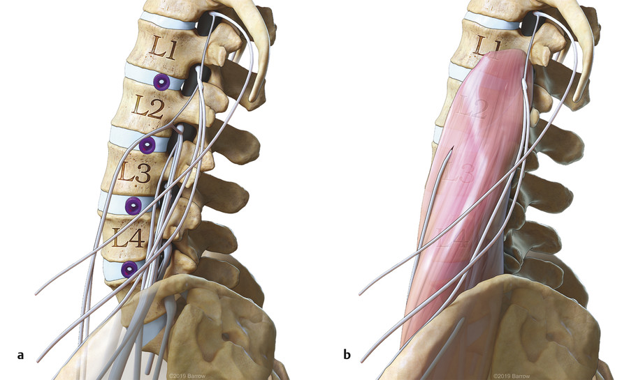 Minimally Invasive Lateral Transpsoas Interbody Lumbar Fusion | Neupsy Key