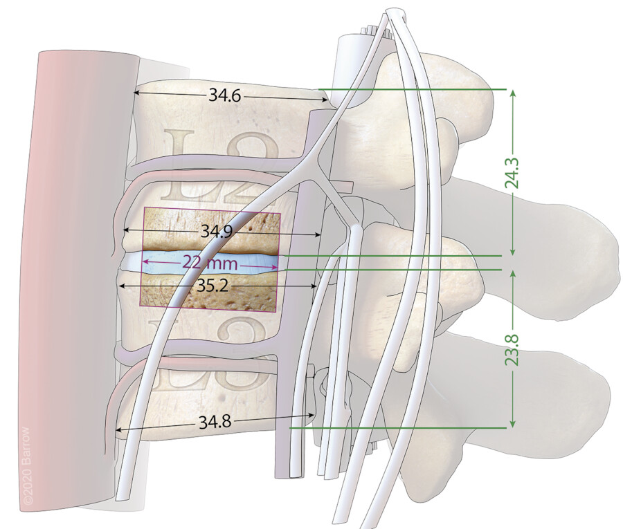 Minimally Invasive Lateral Transpsoas Interbody Lumbar Fusion | Neupsy Key