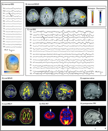 Chapter 8 – Functional MRI in MRI-negative refractory focal epilepsy ...