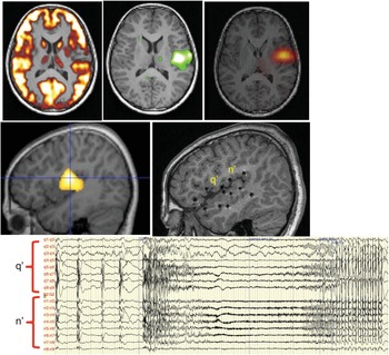 Chapter 4 – PET in MRI-negative refractory focal epilepsy | Neupsy Key