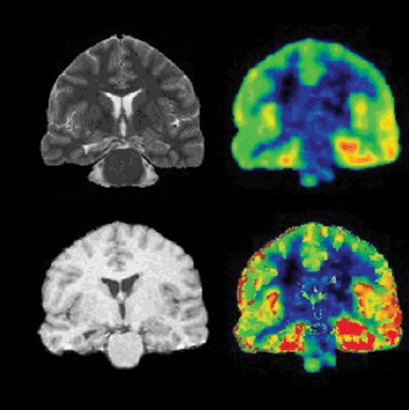 Chapter 19 – Imaging Comorbidities in Epilepsy: Depression | Neupsy Key