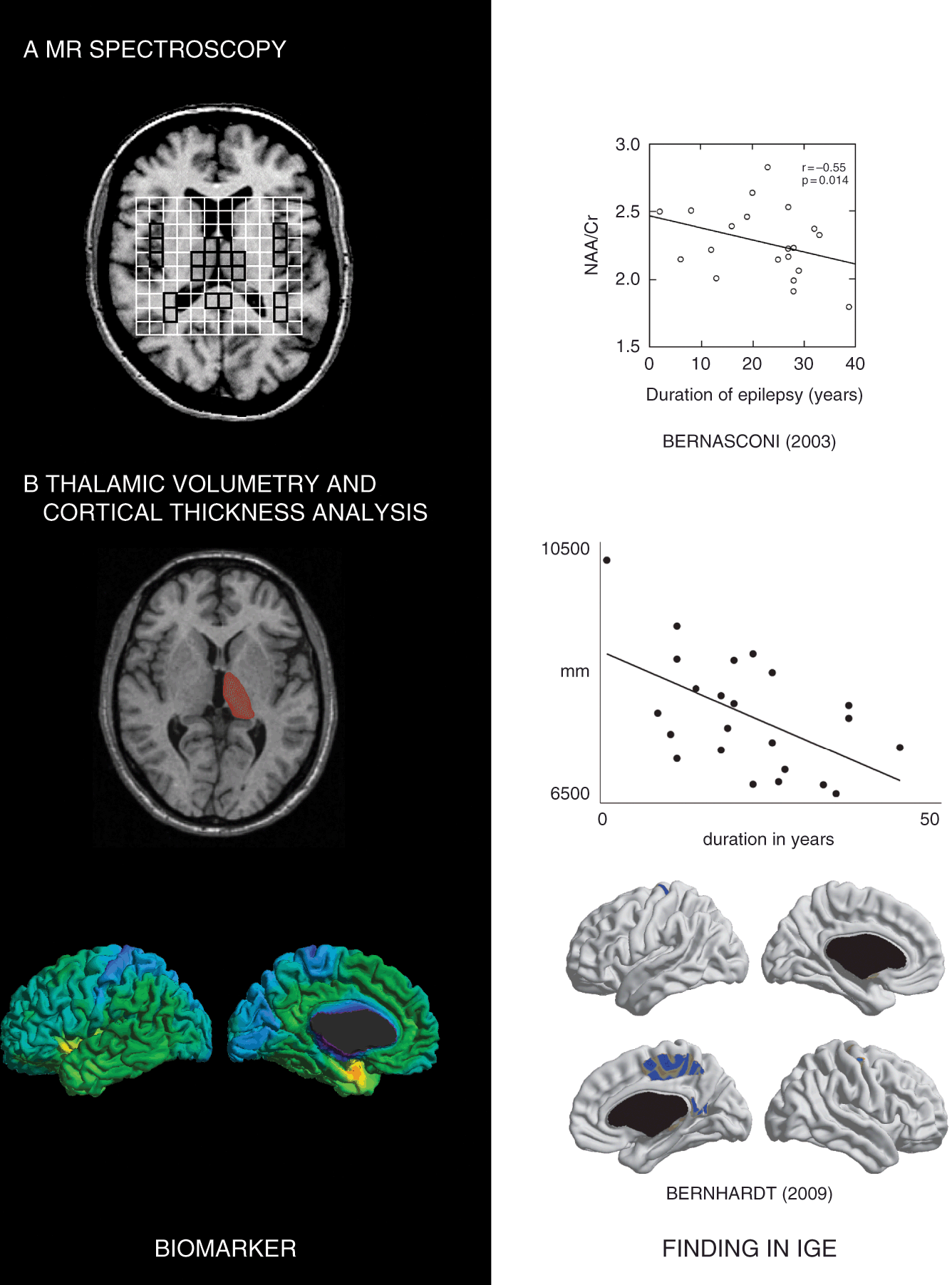 Chapter 20 – Tracking Epilepsy Disease Progression With Neuroimaging ...