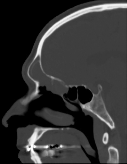 6 Endoscopic Endonasal Skull Base Surgery | Neupsy Key