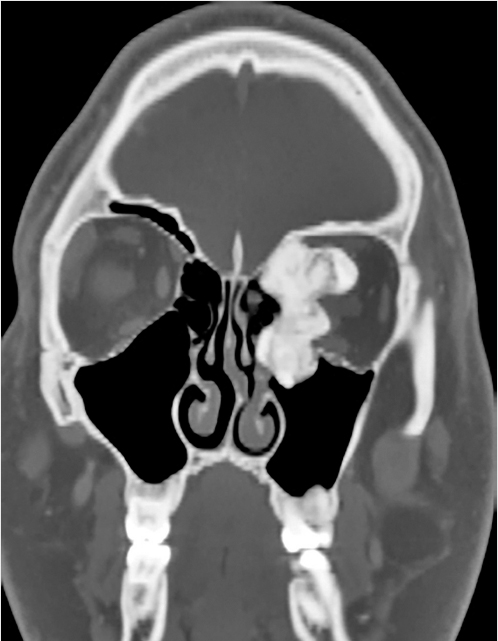 6 Endoscopic Endonasal Skull Base Surgery | Neupsy Key