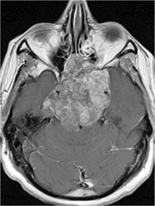 6 Endoscopic Endonasal Skull Base Surgery | Neupsy Key