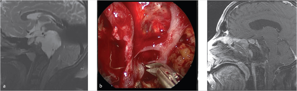 35 Chordomas And Chondrosarcomas Of The Skull Base | Neupsy Key