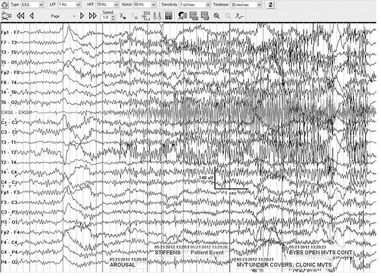 The EEG in Status Epilepticus | Neupsy Key