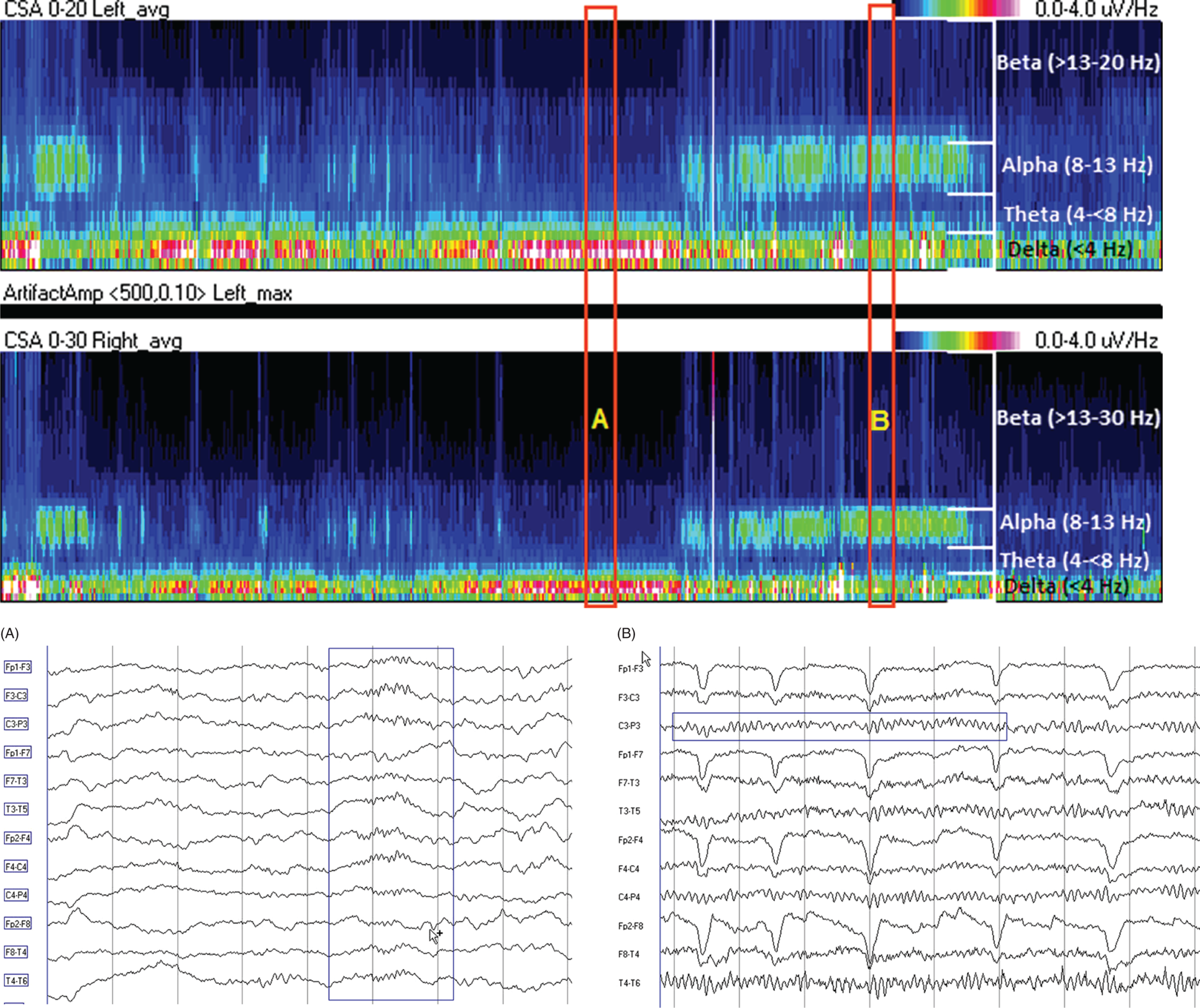 Schematic illustration of spectrogram basics: state changes and alpha rhythm. Schematic illustration of While the patient is asleep (A), most power is in the delta frequency (near the bottom).