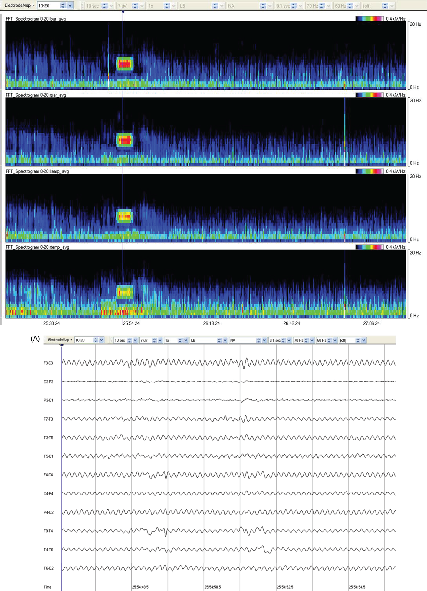 Schematic illustration of spectrogram basics: mechanical artifact – bed oscillator. Schematic illustration of spectrogram basics: mechanical artifact – bed oscillator.