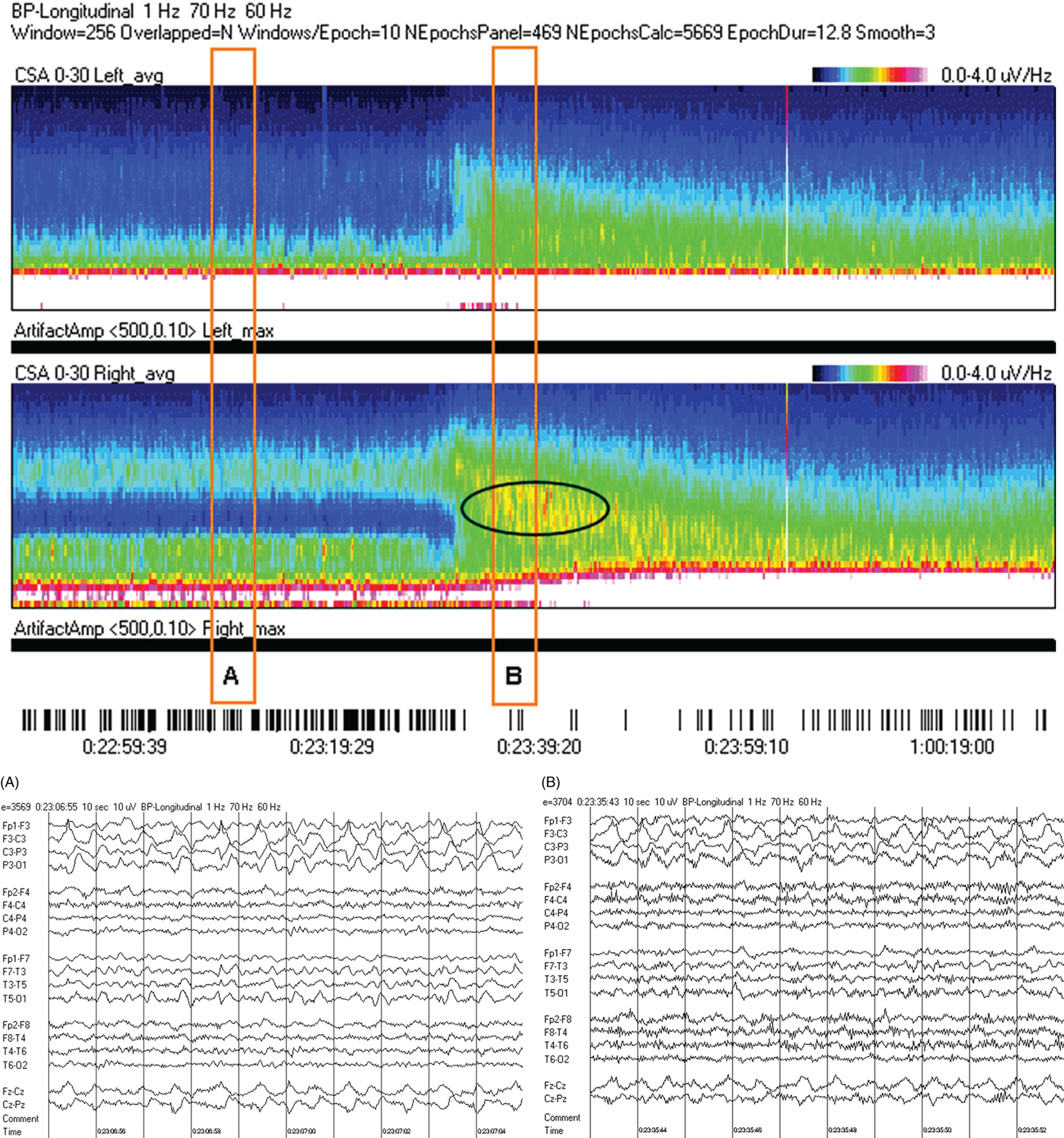 Schematic illustration of spectrogram basics: drug-induced beta and asymmetry. Schematic illustration of At the beginning of the record there is a clear asymmetry with slowing (more delta power) and attenuation (less power in alpha/beta ranges) on the left (A).
