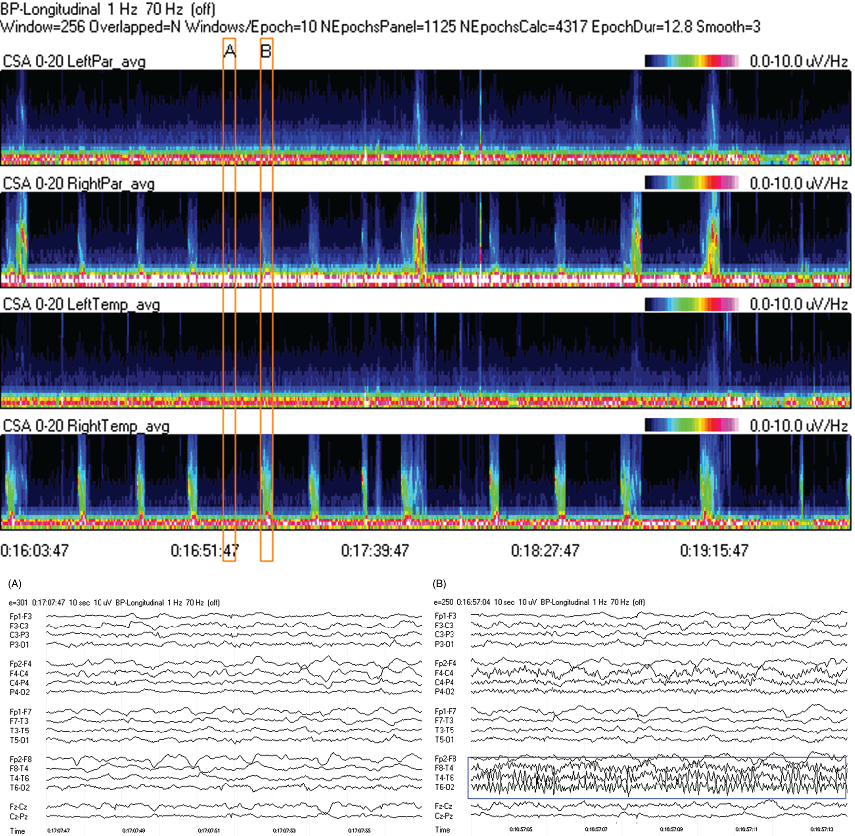 Schematic illustration of spectrogram basics: multiple seizures. Schematic illustration of spectrogram basics: multiple seizures.