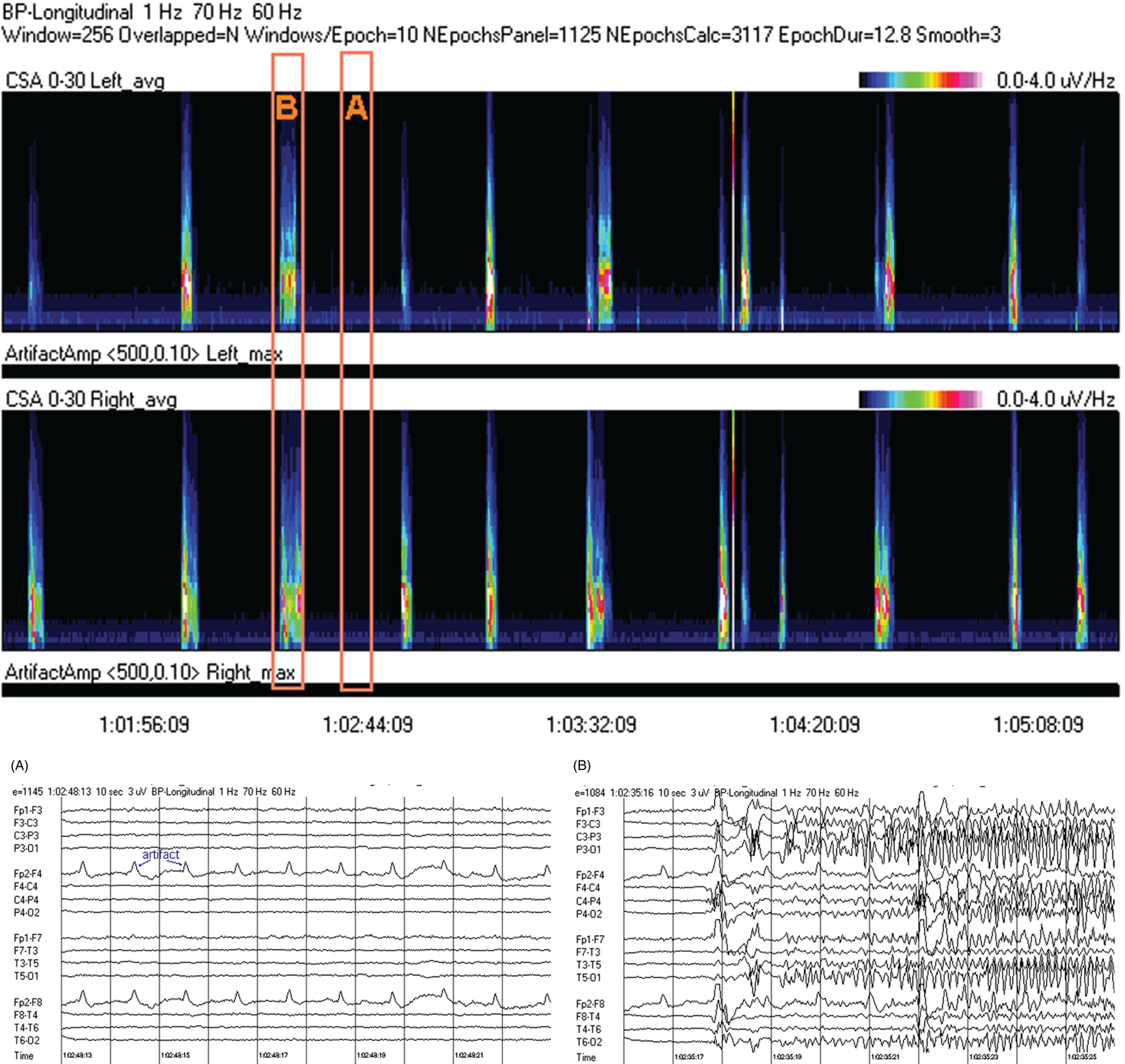 Schematic illustration of spectrogram basics: multiple seizures arising from complete suppression. Schematic illustration of spectrogram basics: multiple seizures arising from complete suppression.