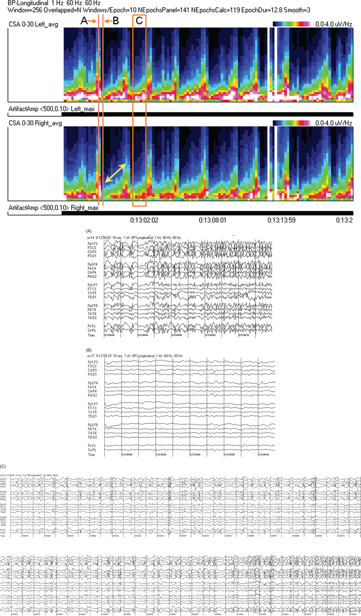 Schematic illustration of spectrogram basics: cyclic nonconvulsive seizures. (c) One minute of raw EEG at C: gradual buildup of epileptiform activity between seizures.