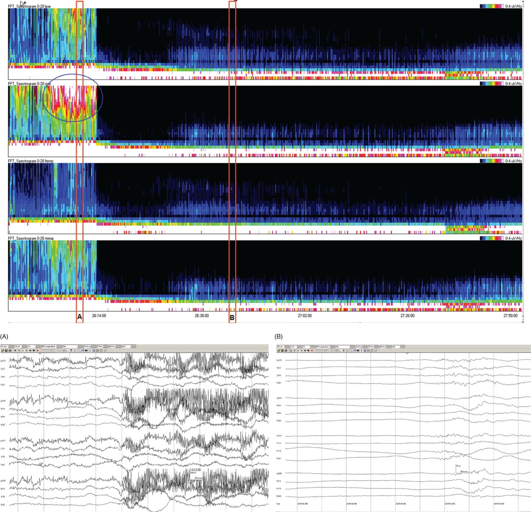 Schematic illustration of spectrogram basics: muscle artifact. Schematic illustration of spectrogram basics: muscle artifact.