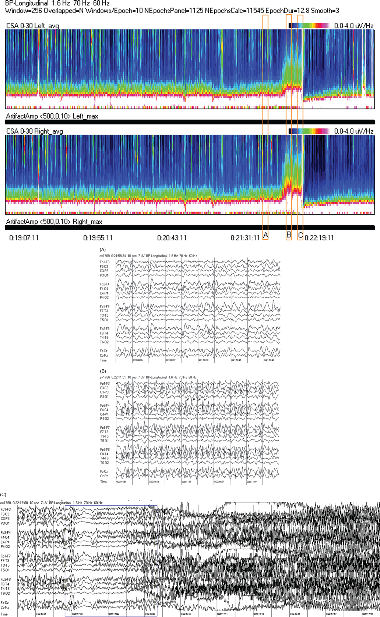 Schematic illustration of spectrogram basics, long-term trends: NCSE culminating with convulsion. (c) EEG at C: transition from NCSE (first few seconds) into a typical generalized tonic-clonic seizure.