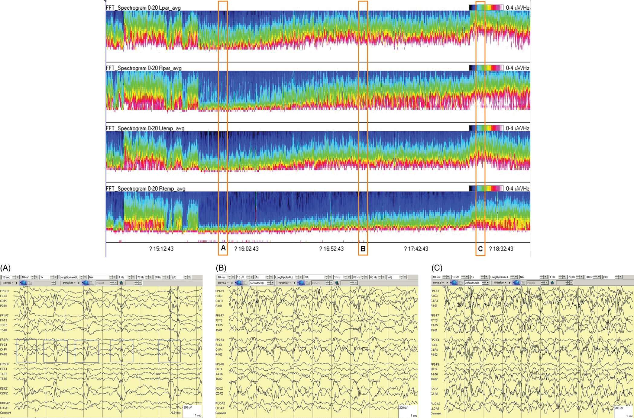 Schematic illustration of spectrogram basics, long-term trends: slow worsening ictal-interictal continuum (IIC) progressing to electrographic status epilepticus (ESE).