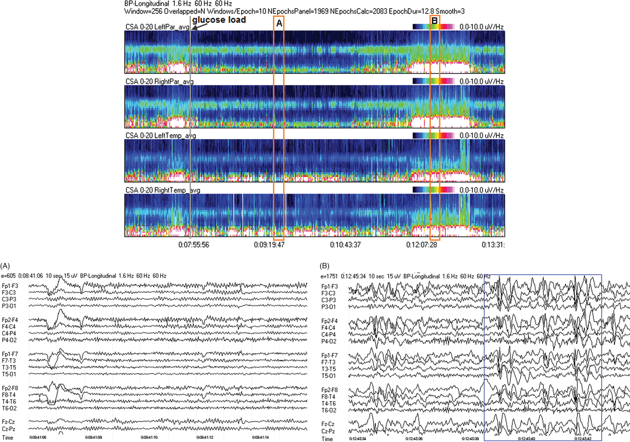 Schematic illustration of spectrogram basics, long-term trends: glucose load effect in glucose transporter deficiency.