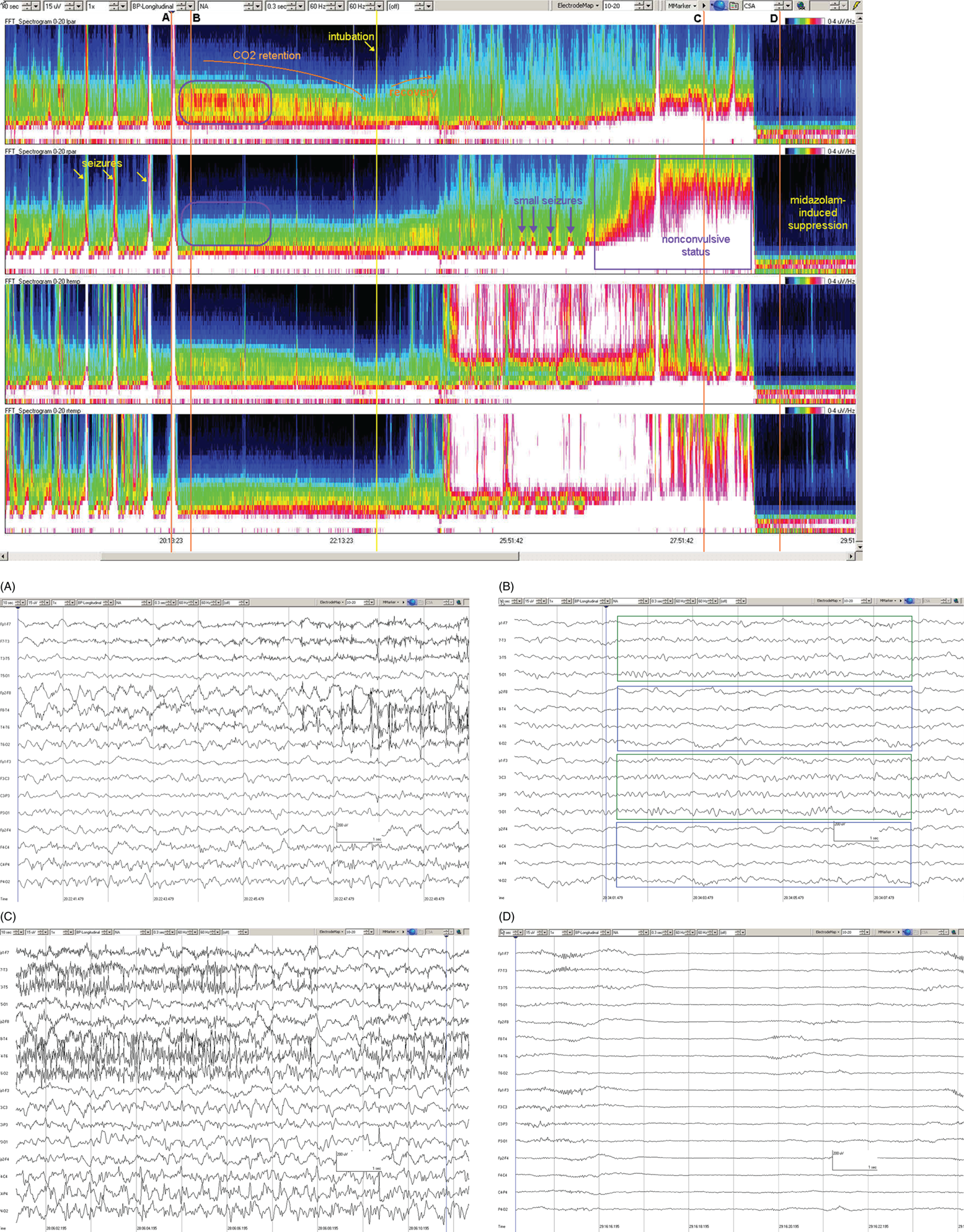 Schematic illustration of spectrogram basics, long-term trends: CO2 retention, acidosis and resolution of nonconvulsive seizures. (a) EEG at A: right hemisphere seizure.