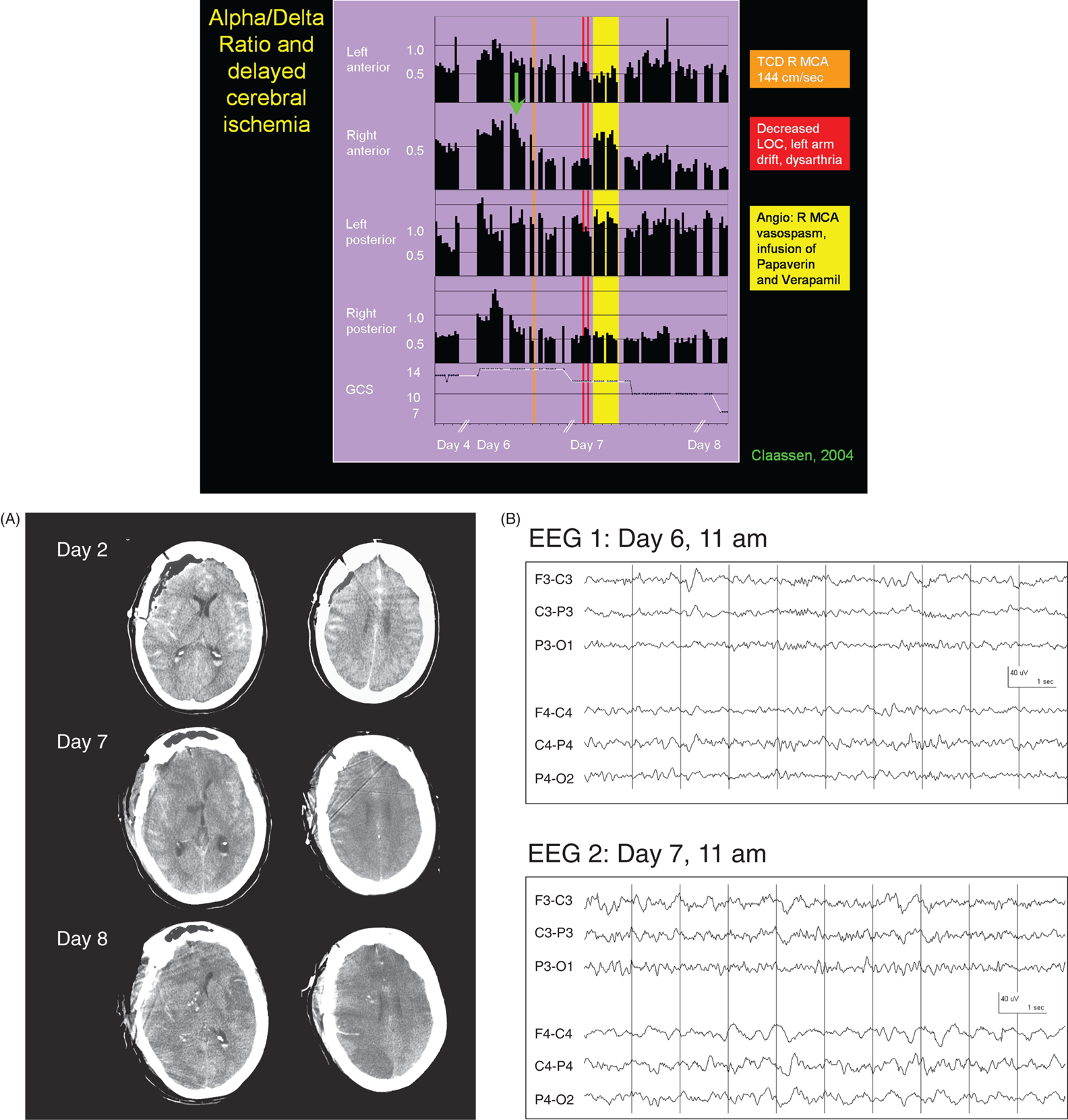 Schematic illustration of ischemia detection: multimodal monitoring for delayed cerebral ischemia after subarachnoid hemorrhage (SAH); alpha-delta ratio. (a) CT scans.