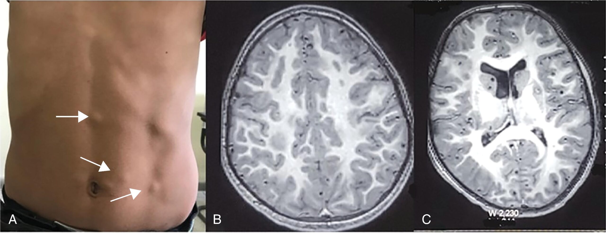 A three panel brain M R I shows sagittal and axial views with abnormal white matter and corpus callosum signal changes.