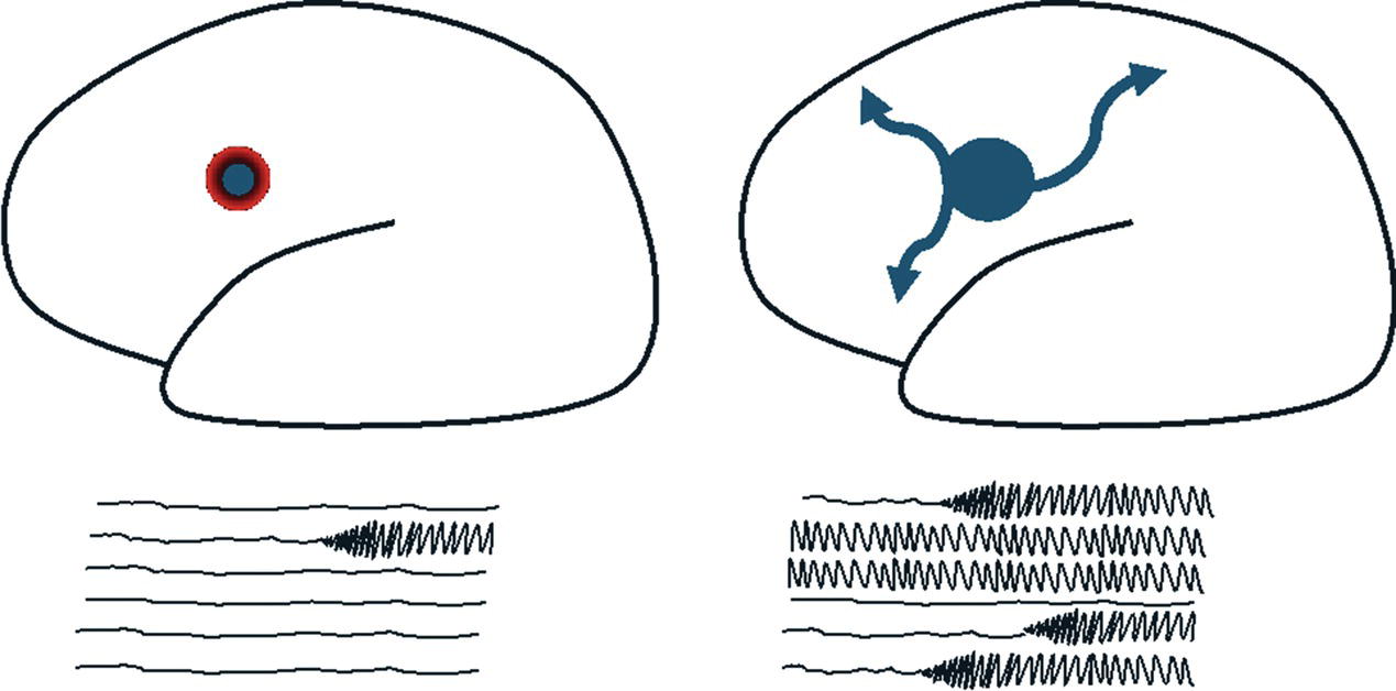 Two brain diagrams compare inhibitory restraint and seizure propagation. The left diagram has a red ring around a blue dot, and the right has a blue dot with arrows, each with a corresponding E E G.