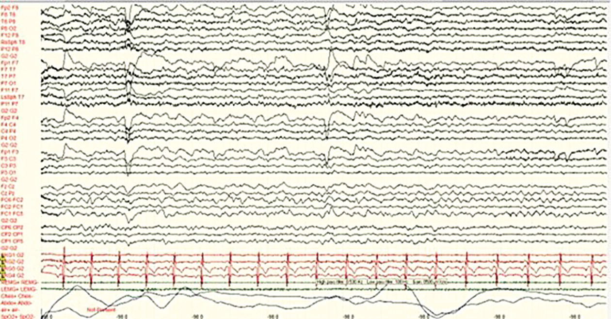 A polygraphic recording shows E E G in black, E C G in red, E M G in green, and respiratory band in blue.