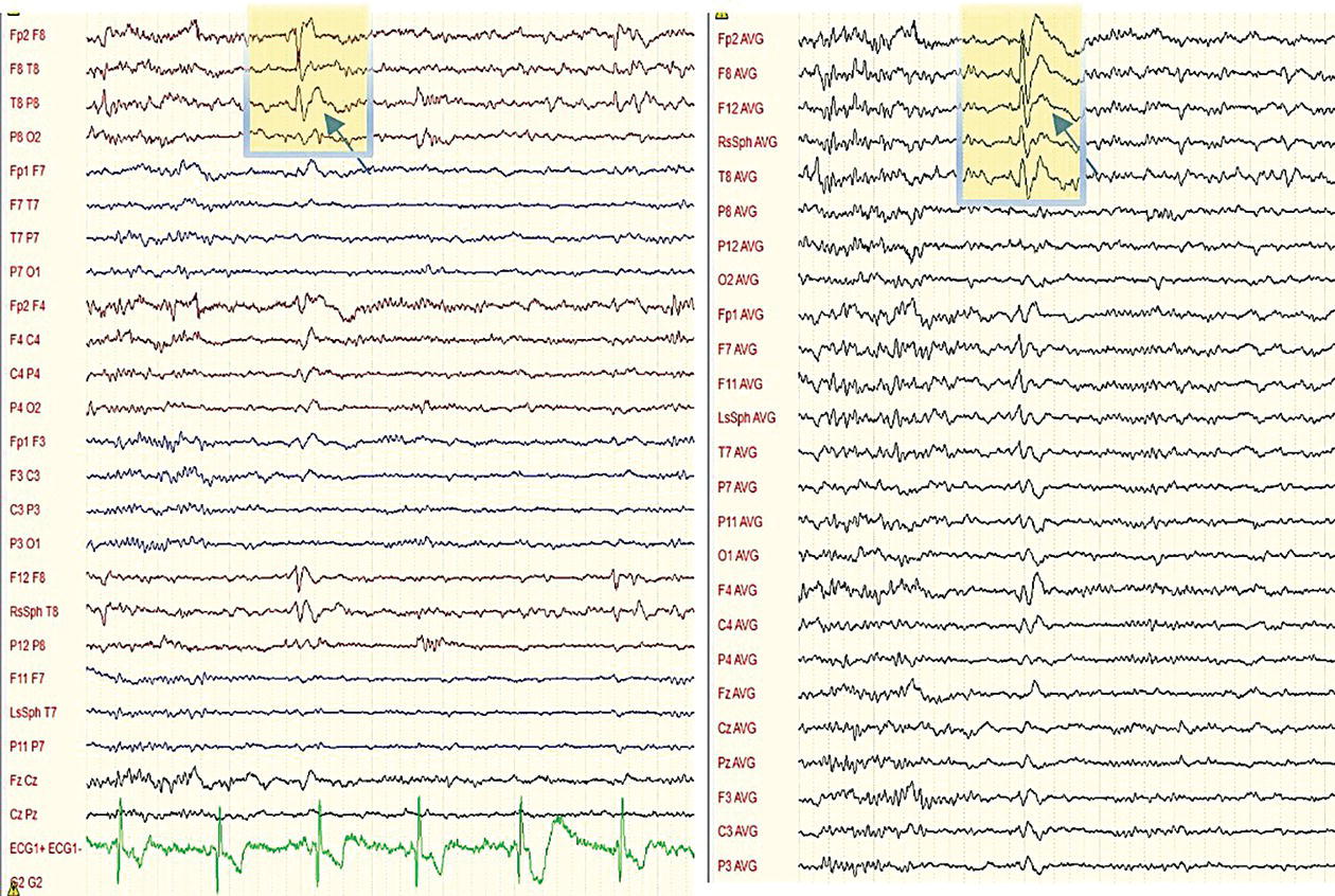 An E E G recording with two parts shows bipolar and referential montages, with a sharp wave in the right temporal region highlighted by an arrow and a box.