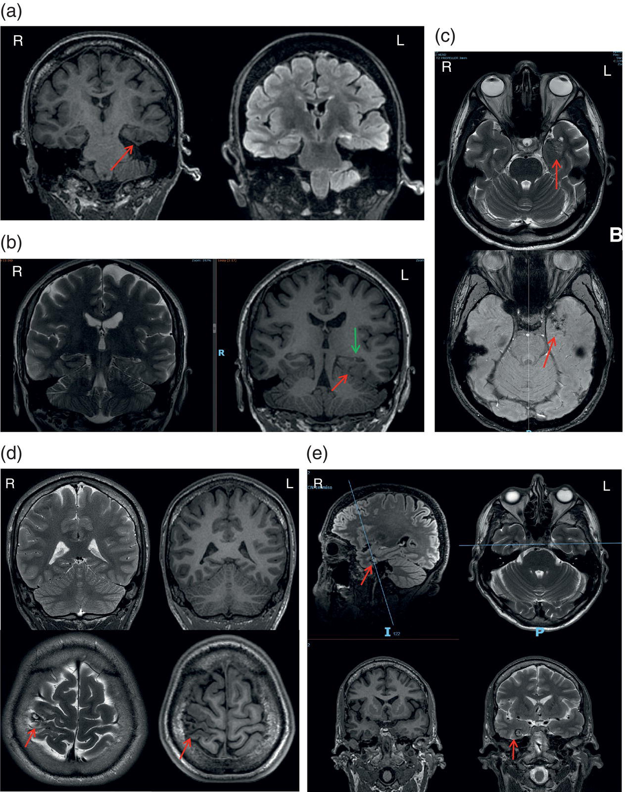 A five-part M R I scan of the brain, labeled A to E, shows different abnormalities and lesions indicated by arrows.