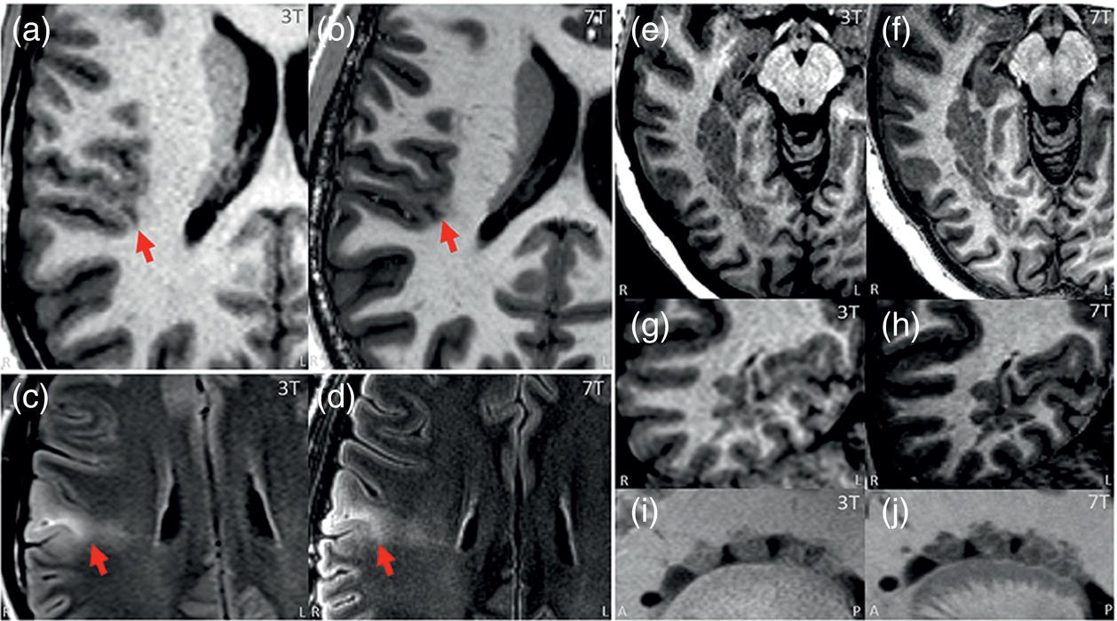 Ten M R I scans, labeled A to J, show the brain at 3 T and 7 T. Images A to D show focal cortical dysplasia, with arrows pointing to the lesion. Images E to J show nodular heterotopia.