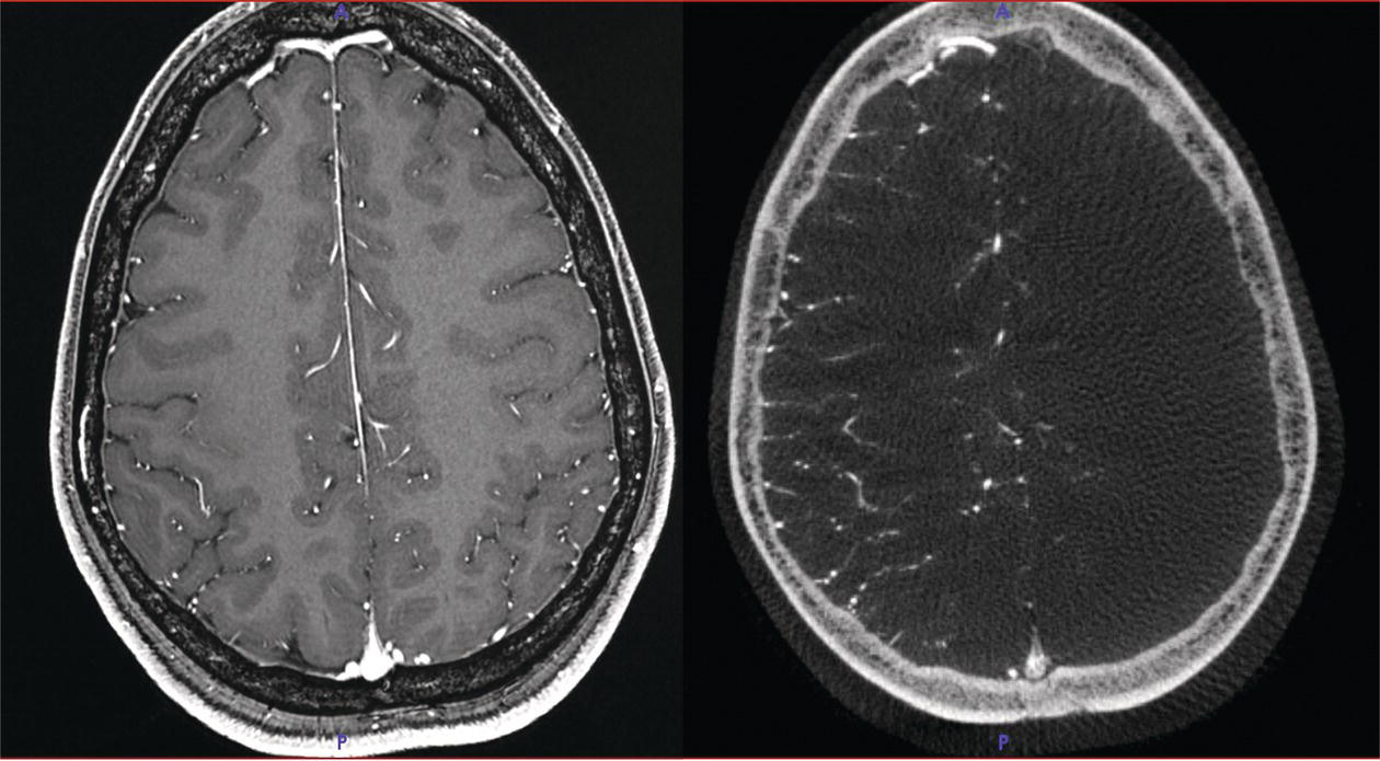 A D S A and an M R I brain scan show the cerebral vasculature.