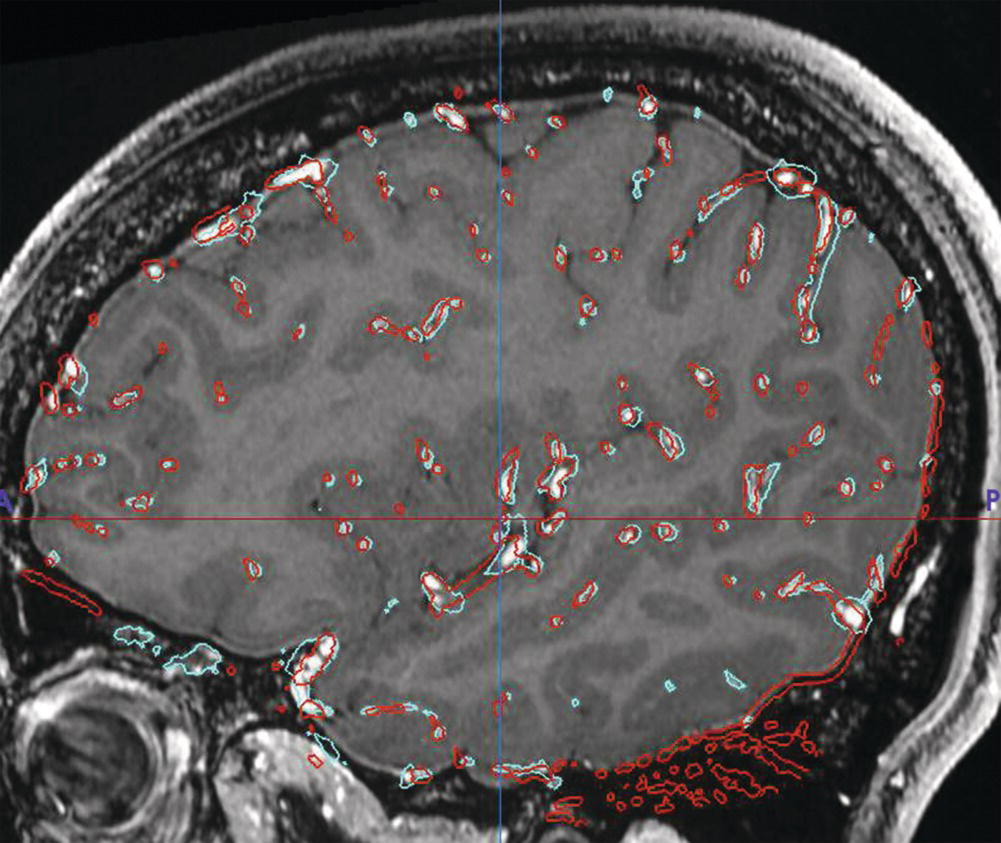 A sagittal M R I scan of a brain with red and cyan outlines highlighting specific areas.