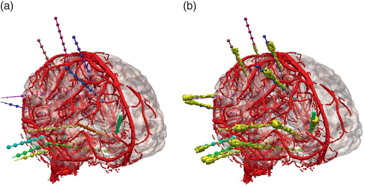Two brain diagrams show arteries and implanted electrodes. Diagram a shows planned electrodes, and diagram b shows segmented electrodes after implantation.