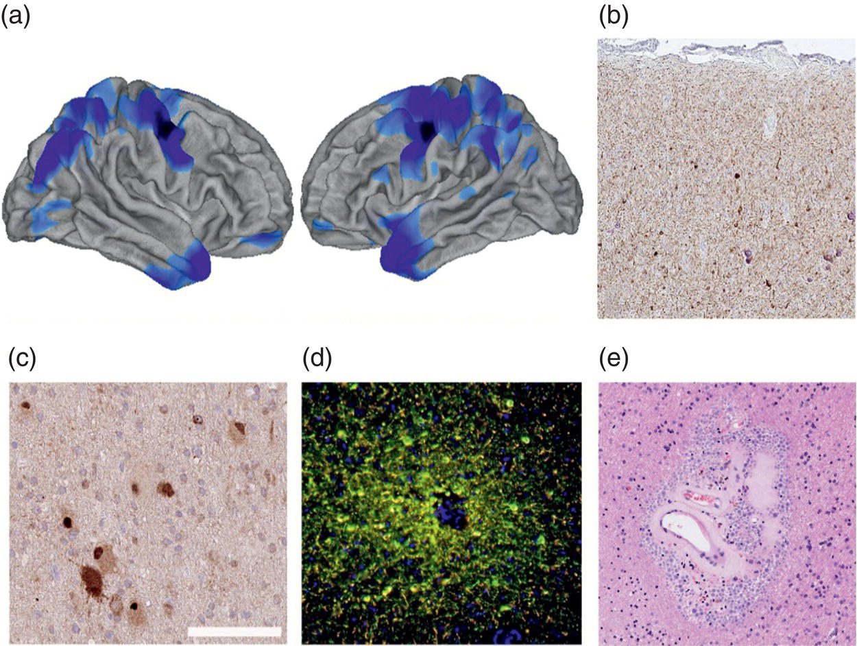 A set of two brain scans and four histology images show neurodegeneration in epilepsy. The images show cortical thinning, p Tau accumulation, and defective autophagy pathways.